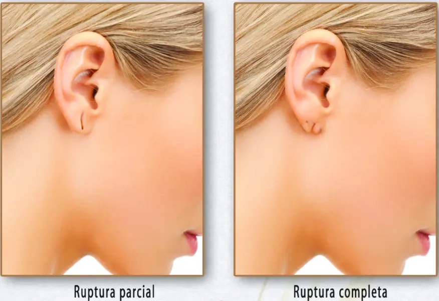 lobuloplastia