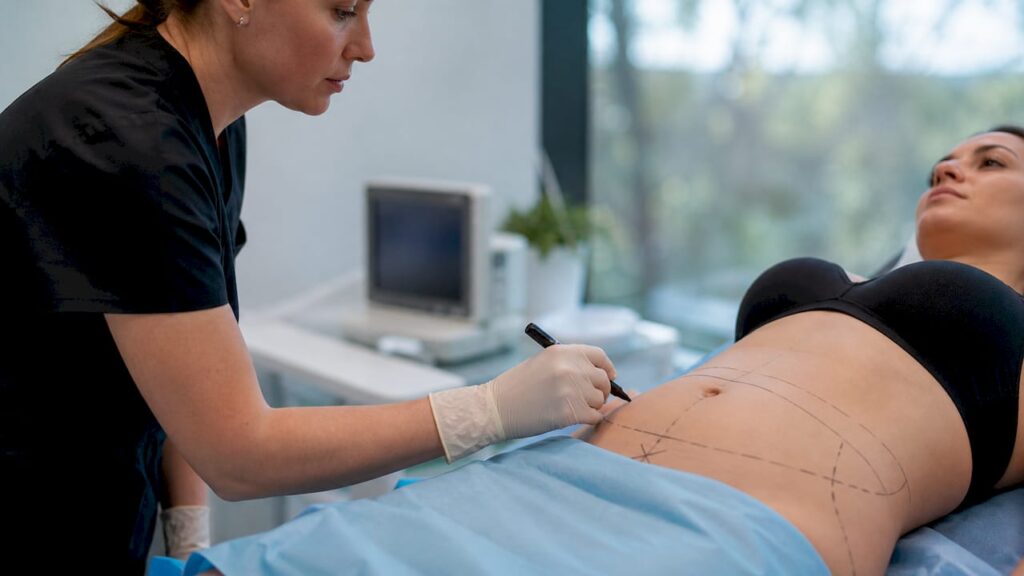 Especialista realizando el marcaje abdominal previo a una liposucción