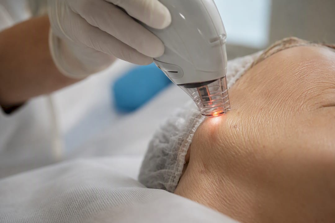 Dispositivo láser no ablativo sobre la piel del rostro