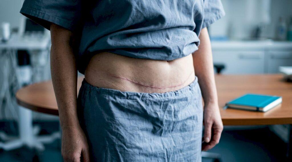 Cicatriz baja tras abdominoplastia