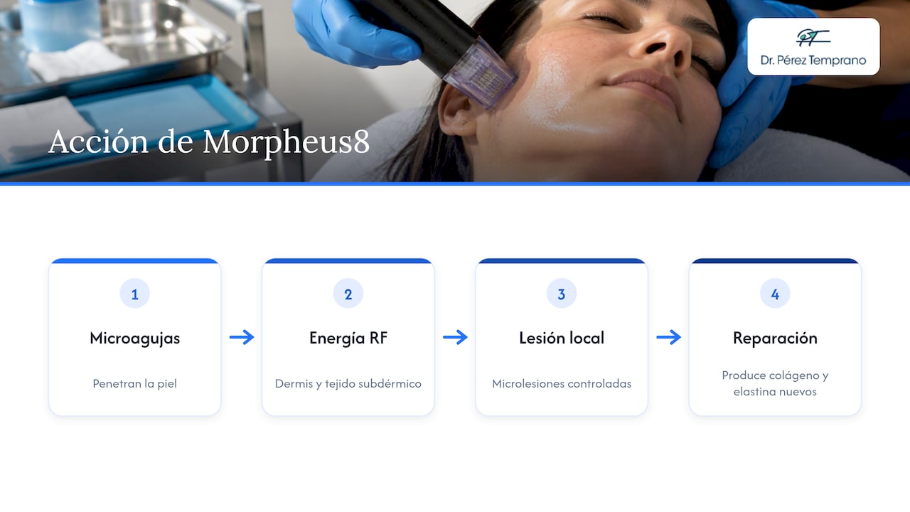 Qué hace Morpheus8 y por qué el número de sesiones varía — overview diagram